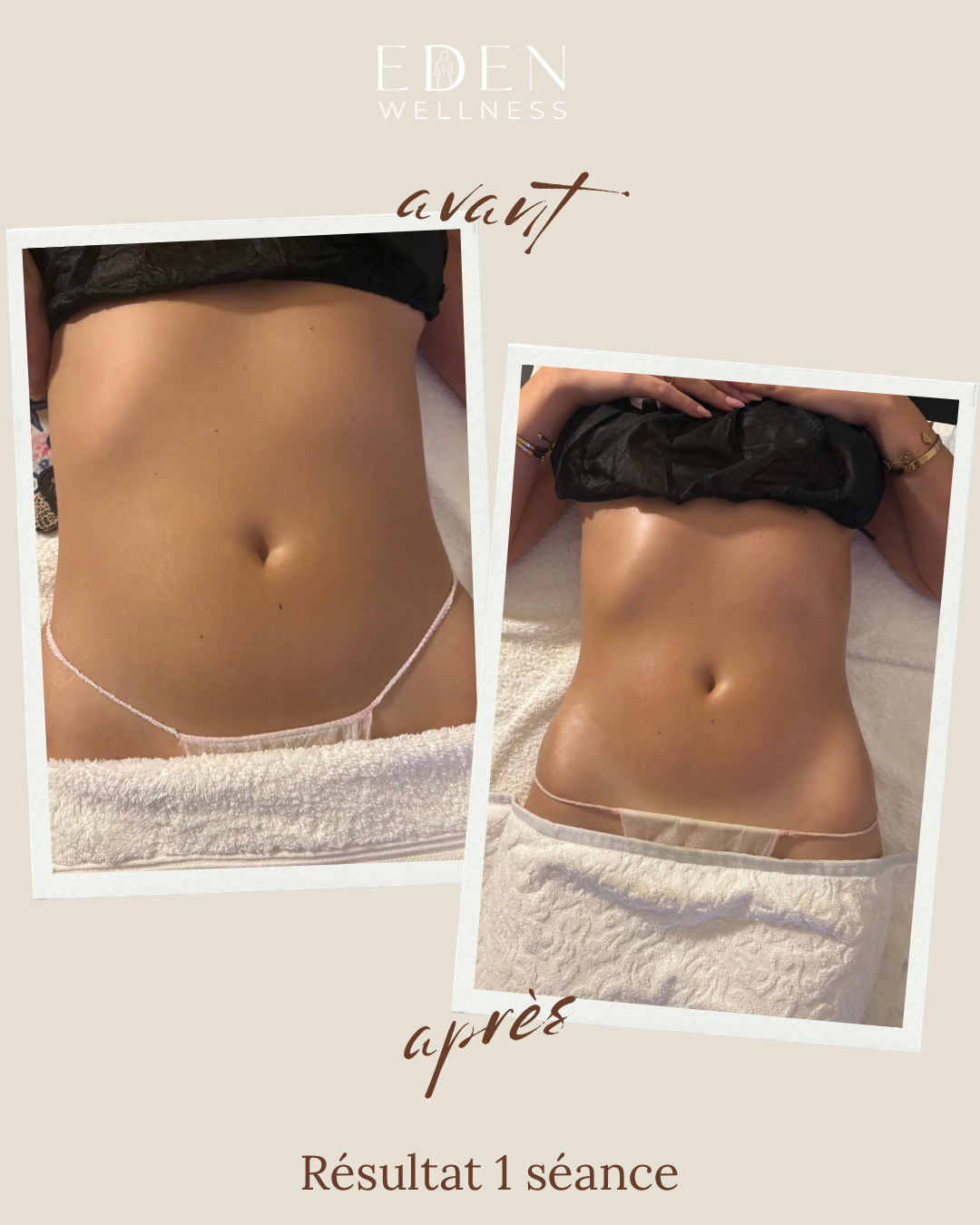Photo comparative avant et après une séance de maderothérapie sur la zone abdominale, montrant une réduction visible du tour de taille