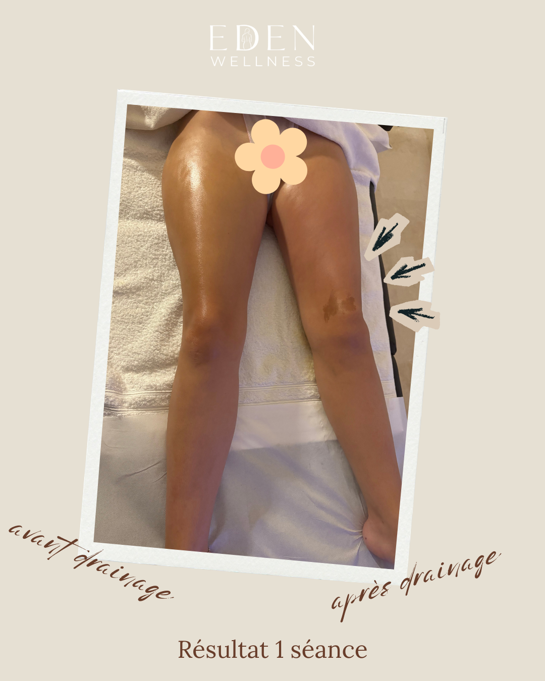 Avant après drainage lymphatique jambes — résultat 1 séance Eden Wellness