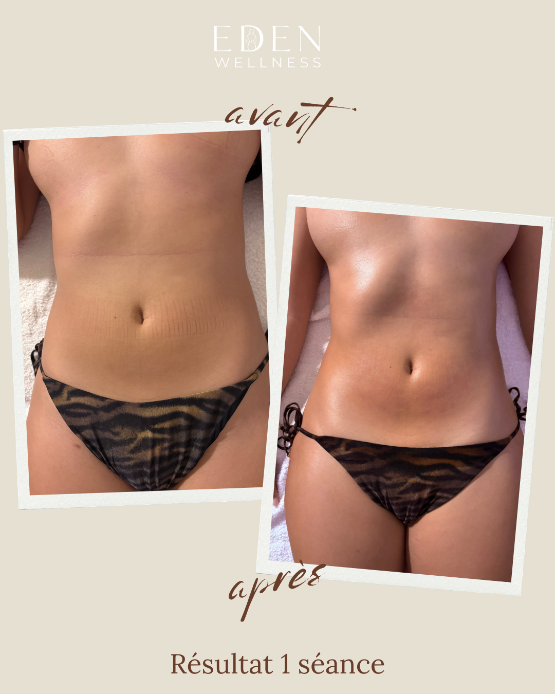 Avant après maderothérapie taille — résultat 1 séance Eden Wellness