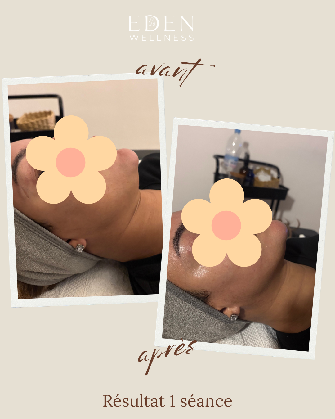 Avant après drainage lymphatique visage — résultat 1 séance Eden Wellness